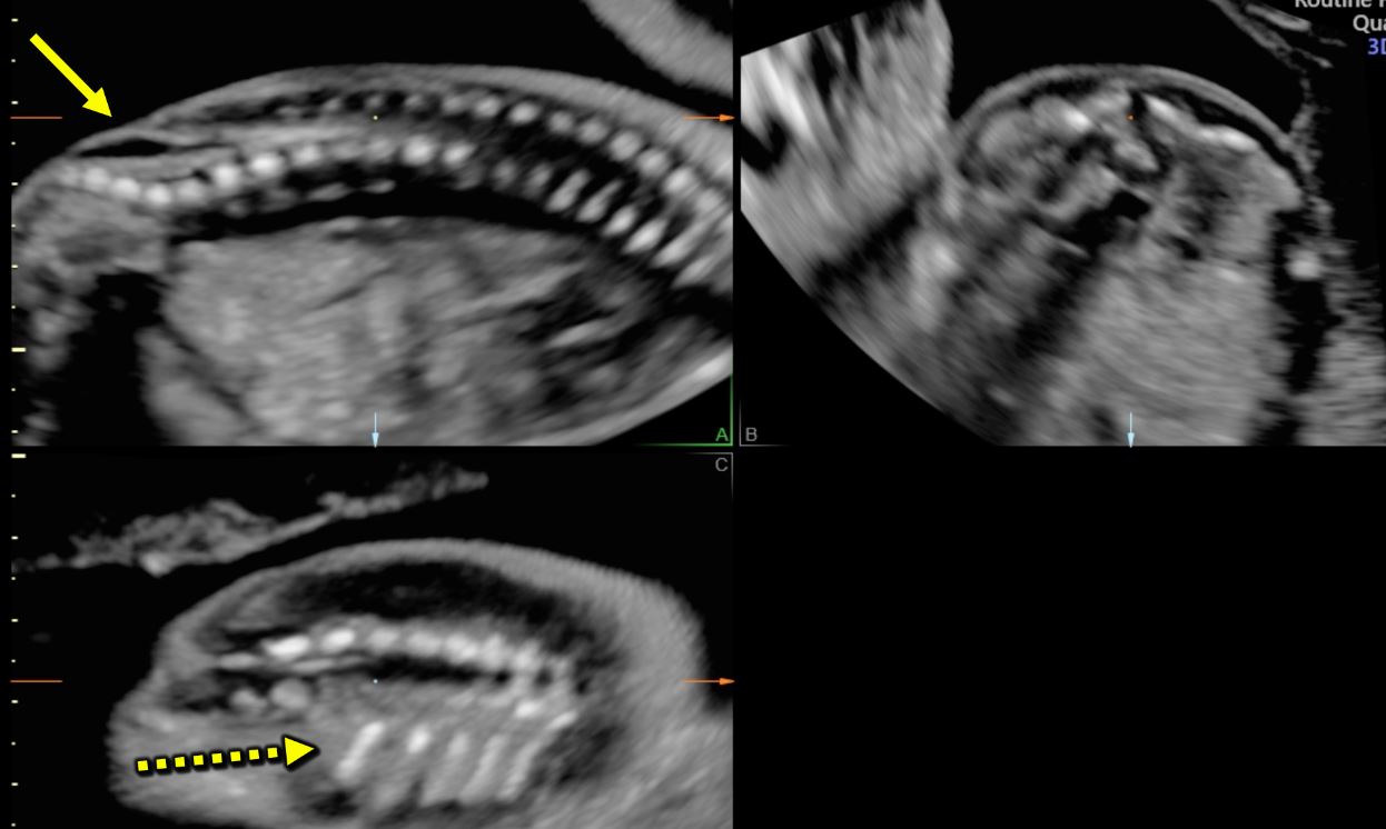 Ultrasound Evaluation of the Neural Tube Article GLOWM